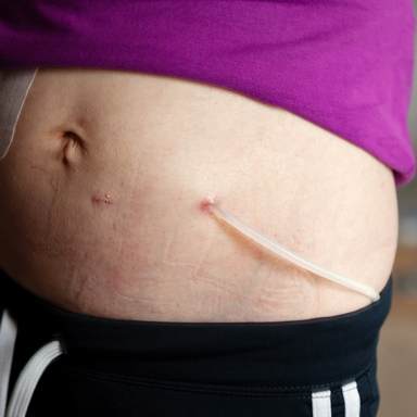 Peritoneal-Dialysis-Exit-Site